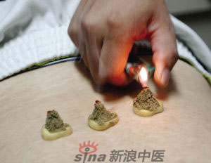 灸法的種類  你知道多少？
